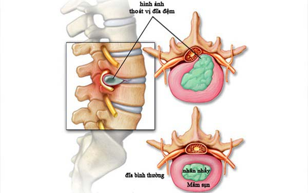 Nỗi ám ảnh từ các căn bệnh cột sống