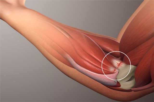 Điều trị đau khớp khuỷu tay hiệu quả dứt điểm