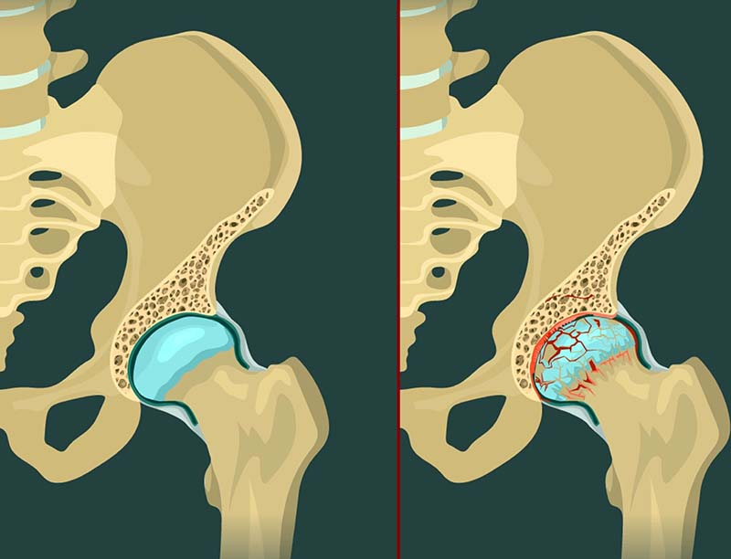 Biểu hiện cảnh báo thoái hóa khớp háng