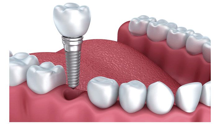 trong-rang-implant (2).jpg